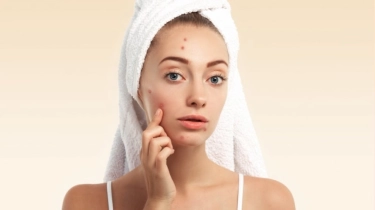 5 Rekomendasi Moisturizer yang Ampuh Hilangkan Bekas Jerawat, Kulit Jadi Mulus dan Cerah