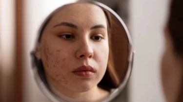 Dermatolog Sarankan Pakai Thermal Water untuk Jerawat dan Iritasi Kulit, Ini Alasannya