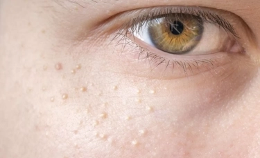 6 Cara Menghilangkan Benjolan Putih atau Milia di Wajah Secara Alami