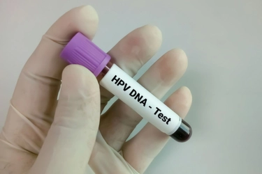Kenali HPV yang Diduga Jadi Penyebab Naiknya Kasus Kanker di Kalangan Anak Muda India