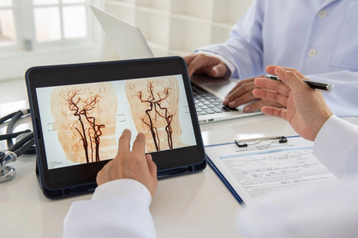 Cegah Stroke dengan Cek Aliran Darah ke Otak 