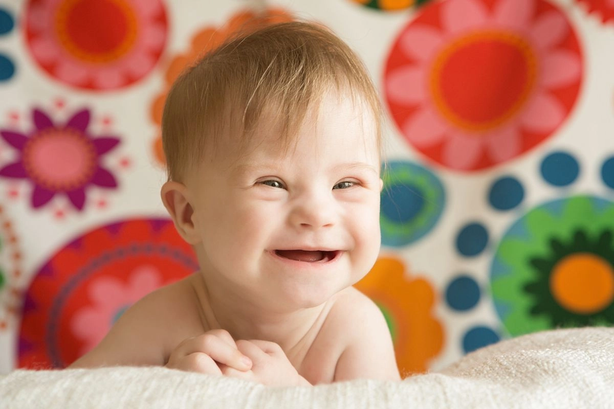 Kenali Penyebab Kelainan Bawaan pada Anak, Termasuk Down Syndrome