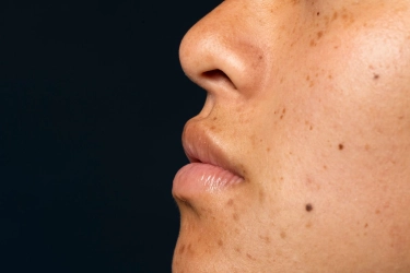Apakah Kojic Acid Efektif Memudarkan Flek Hitam?