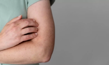 Pernah Merasakan Kulit Gatal dan Kemerahan Mendadak? Waspada Biduran, Pahami Penyebab, Gejala, dan Cara Mengatasinya