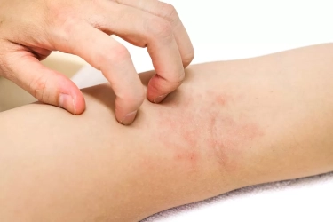 Rahasia di Balik Kulit Kering pada Eksim, Akibat Penguapan Air pada Kulit yang Meningkat