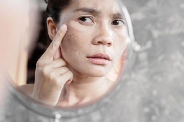 Jangan Salah, Ketahui Beda Flek Hitam akibat Penuaan dan Melanoma