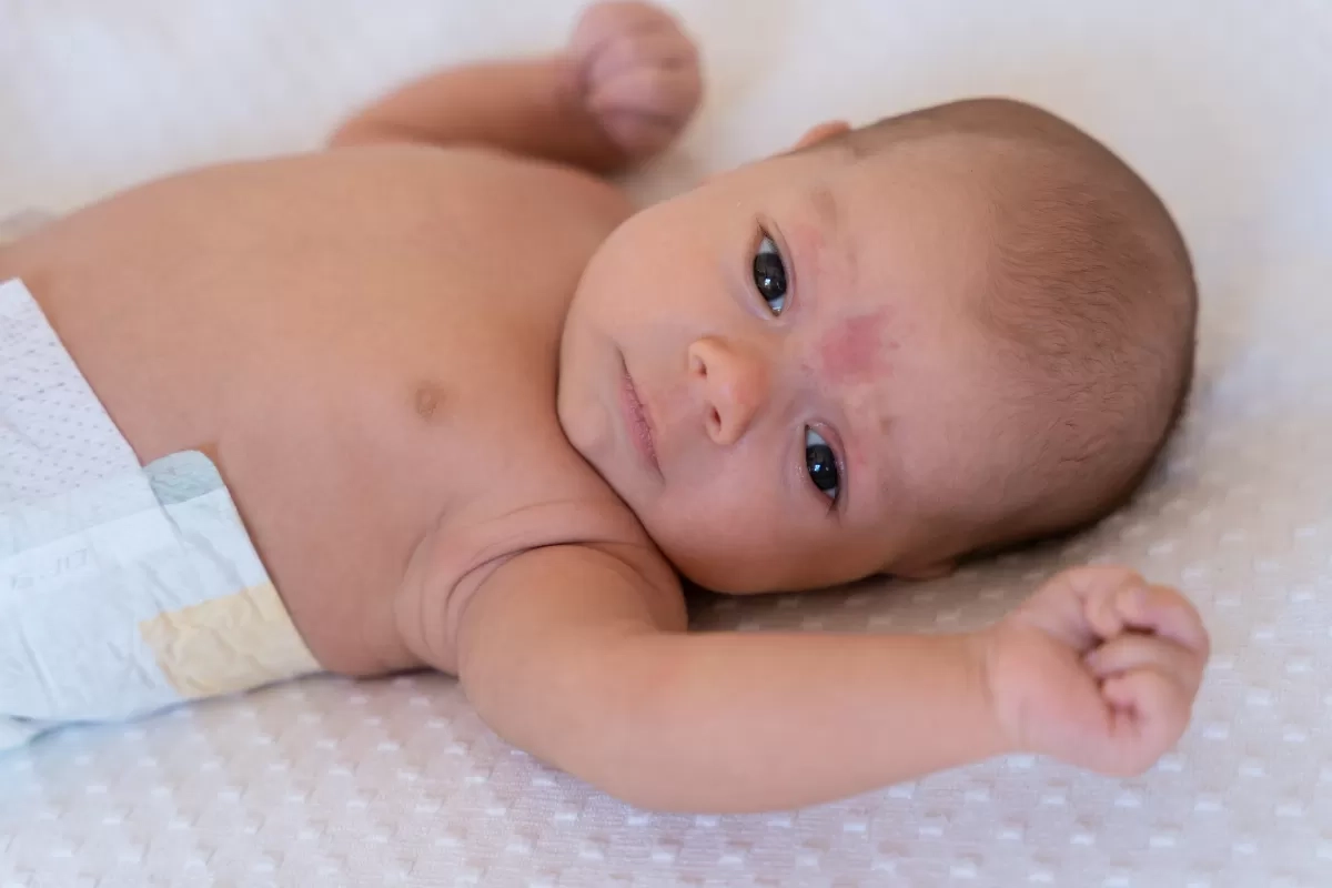 Ketahui Jenis-jenis Tanda Lahir serta Penyebabnya Bisa Terjadi Pada saat Bayi
