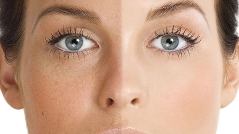 Gosong usai Terpapar Matahari? Ini 5 Cara Mengembalikan Warna Kulit Belang