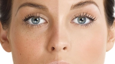 Gosong usai Terpapar Matahari? Ini 5 Cara Mengembalikan Warna Kulit Belang