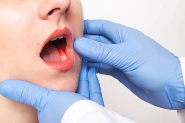 Waspadai 2 Masalah Kesehatan Gusi yang Sering Diabaikan, Bisa Jadi Silent Killer