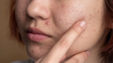 10 Kebiasaan Skincare yang Bisa Membuat Jerawat Muncul Lebih Parah