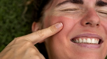 4 Rekomendasi Toner untuk Meredakan Kulit Sunburn akibat Paparan Matahari