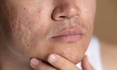 5 Cara Mengurangi Tampilan Pori-Pori Terbuka, Wajah Jadi Tampak Halus Merata