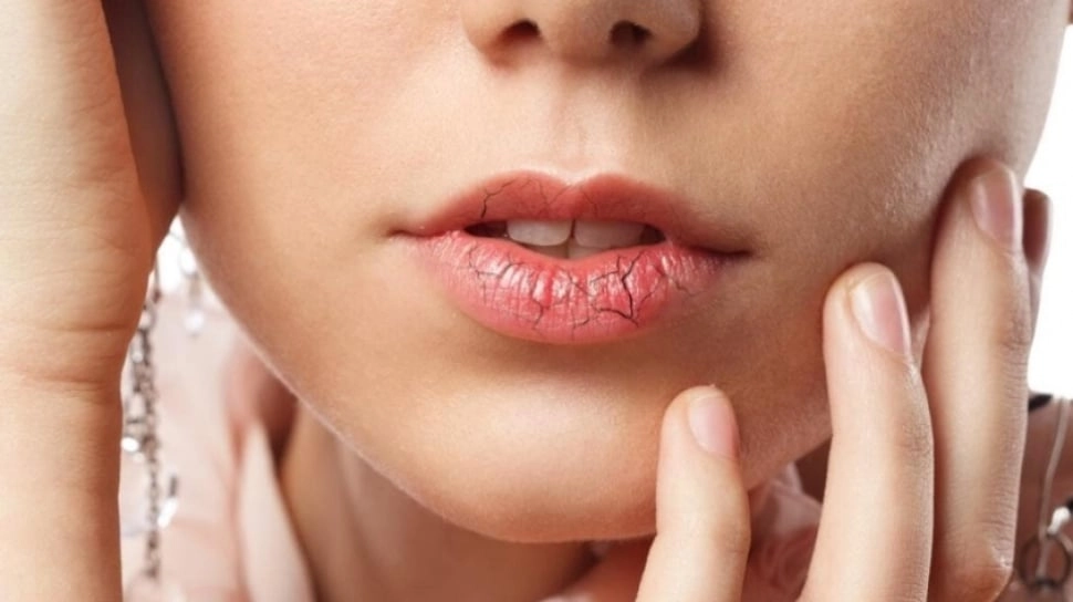 Bibir Kering dan Pecah? Waspada, Tubuh Sedang Kekurangan Salah Satu dari 7 Vitamin Ini