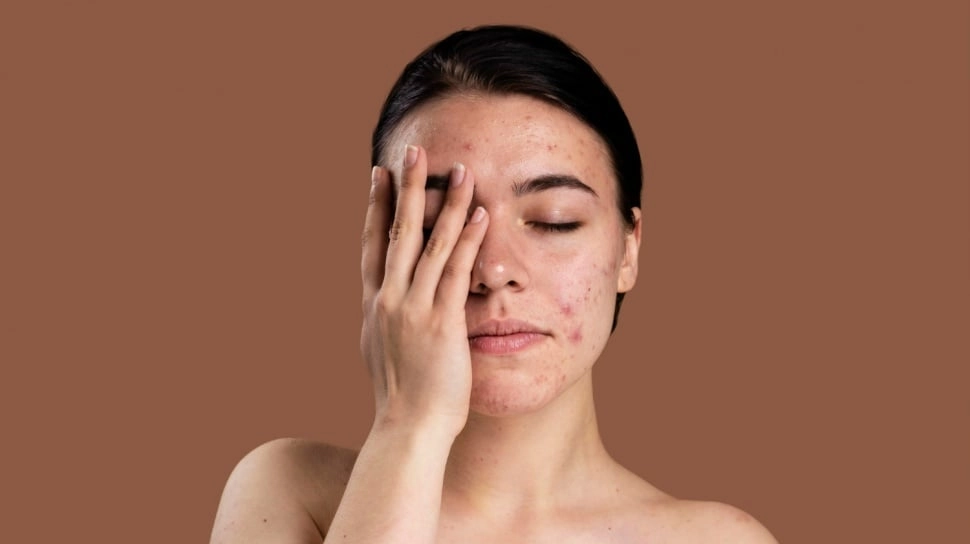 5 Face Wash Mengandung Salicylic Acid, Hempaskan Kulit Berjerawat Membandel