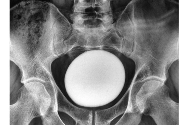 Tanpa Nyeri Hebat, Batu Saluran Kemih 826 Gram Baru Terungkap Saat Diperiksa Dokter