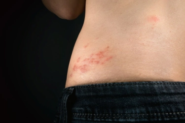 Mengapa Orang yang Pernah Cacar Air Masih Berisiko Cacar Api? Dokter Jelaskan