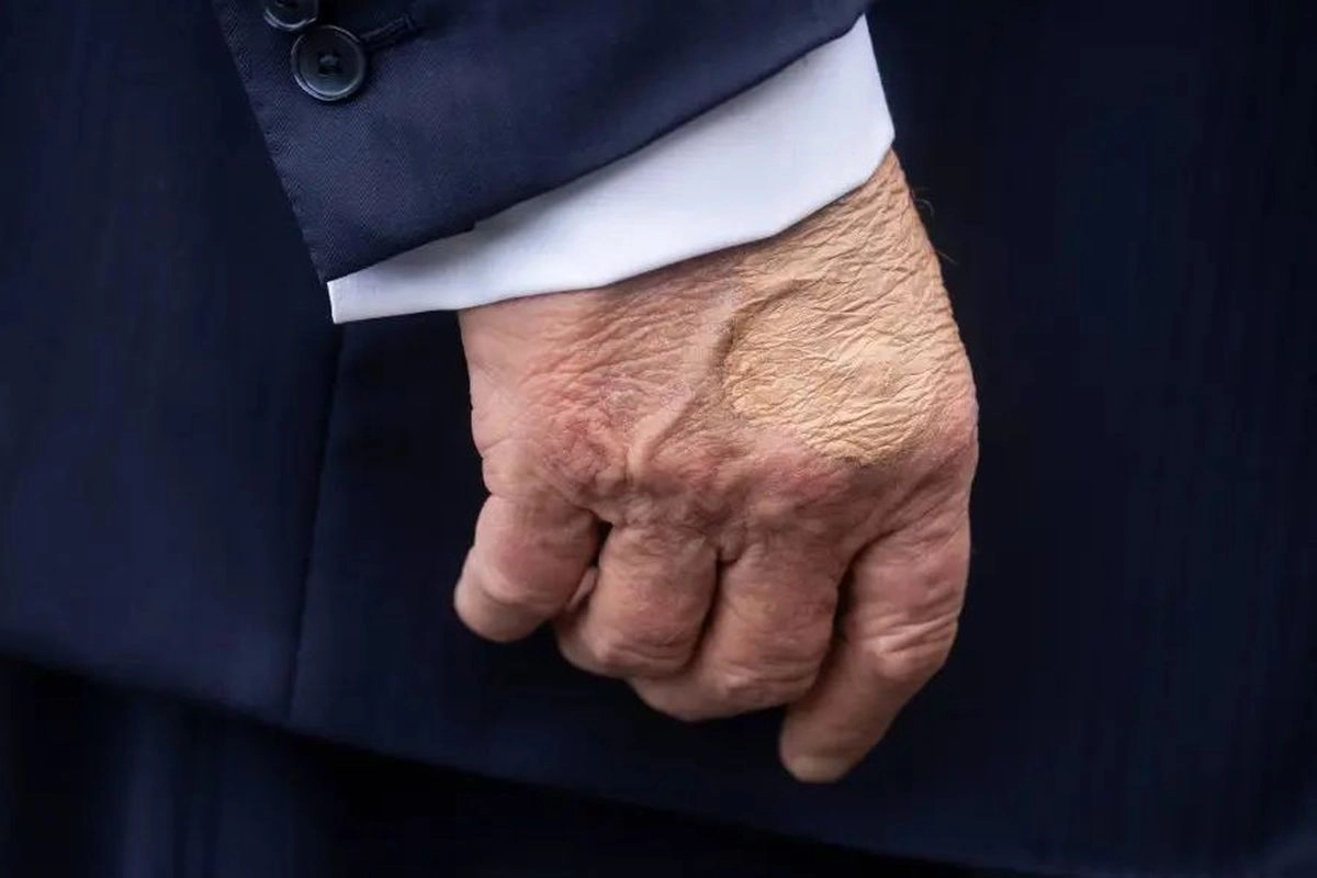 Memar di Tangan Donald Trump Disebut Akibat Aspirin Dosis Tinggi, Dokter Ingatkan Risikonya