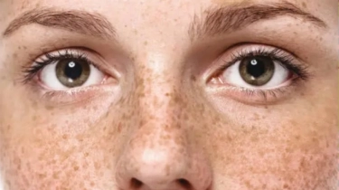 5 Kandungan Skincare yang Harus Dihindari agar Flek Hitam Tidak Makin Parah