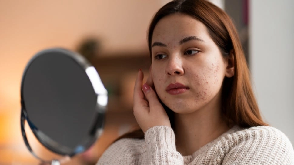 7 Rekomendasi Serum Penghilang Bekas Jerawat, Bikin Kulit Cerah Merata