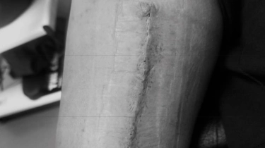 Marselino Ferdinan Pamer Bekas Jahitan Operasi