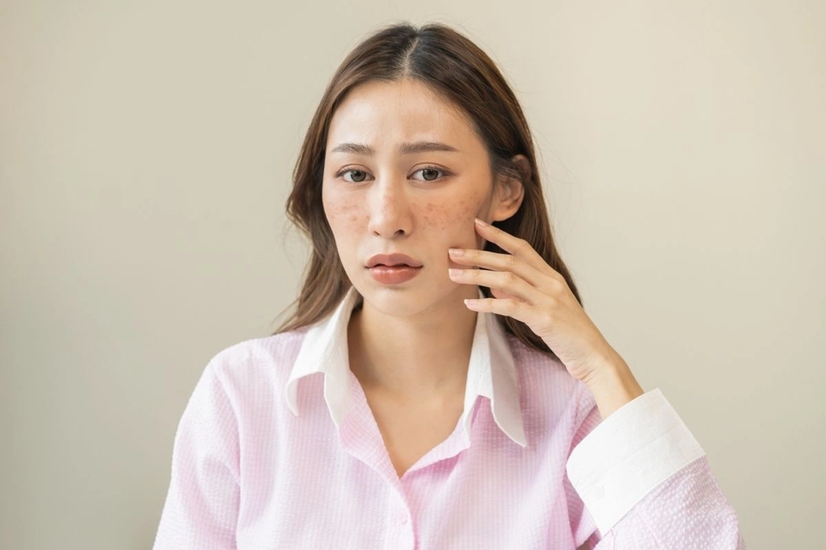 Melasma Tak Kenal Usia, Bukan Hanya Dialami Usia 40 Tahun ke Atas