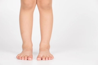 Bentuk Kaki X dan O pada Anak, Kapan Orangtua Harus Waspada?