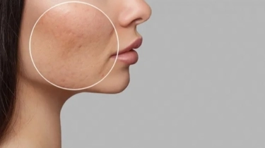 7 Rekomendasi Produk Skincare Yang Bantu Atasi Bopeng di Wajah