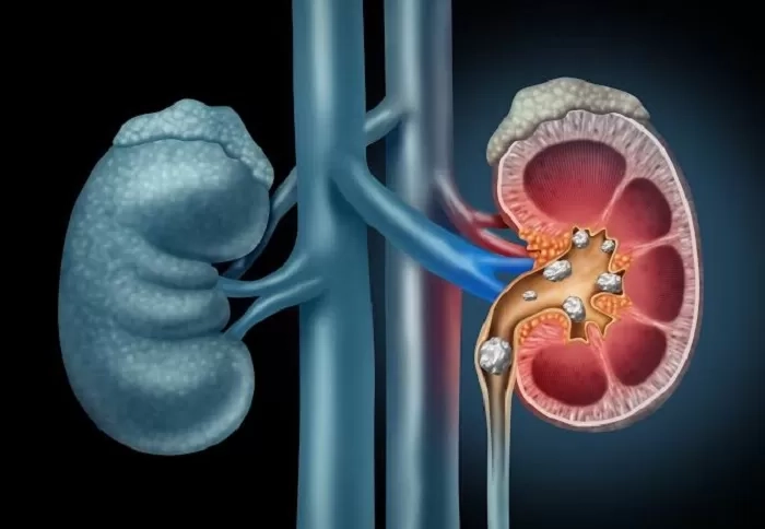 Mengenal Keunggulan Bedah Urologi dengan Robotic Da Vinci, Efek Samping Minim hingga Ketentuannya