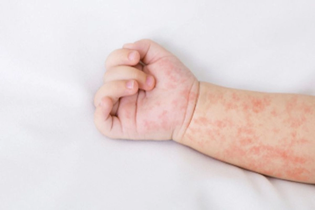 Tak Hanya Ruam, Campak Bisa Melemahkan Sistem Kekebalan Tubuh Anak dan Memicu Penyakit Lain