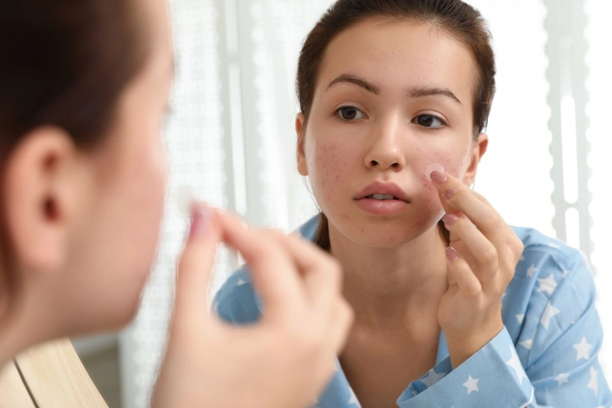 Membedakan Jerawat di Bibir dengan Herpes