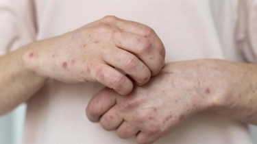 Apa yang Harus Dilakukan jika Terkena Campak? Ini 8 Langkah Penting agar Tidak Menular