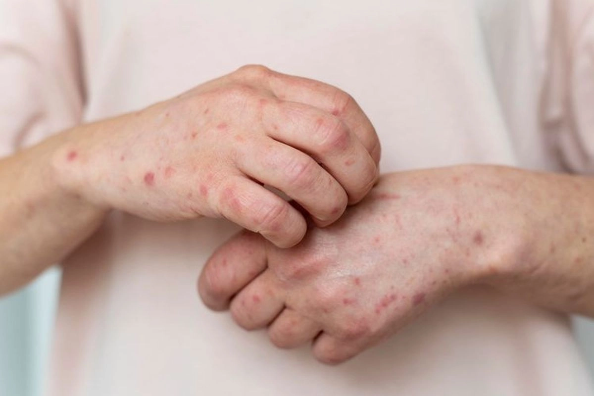 Pentingnya Herd Immunity, Lindungi Lansia dan Anak dari Campak