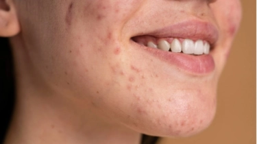 5 Moisturizer untuk Kulit Bruntusan Mulai Rp30 Ribuan, Bisa Meredakan Kemerahan