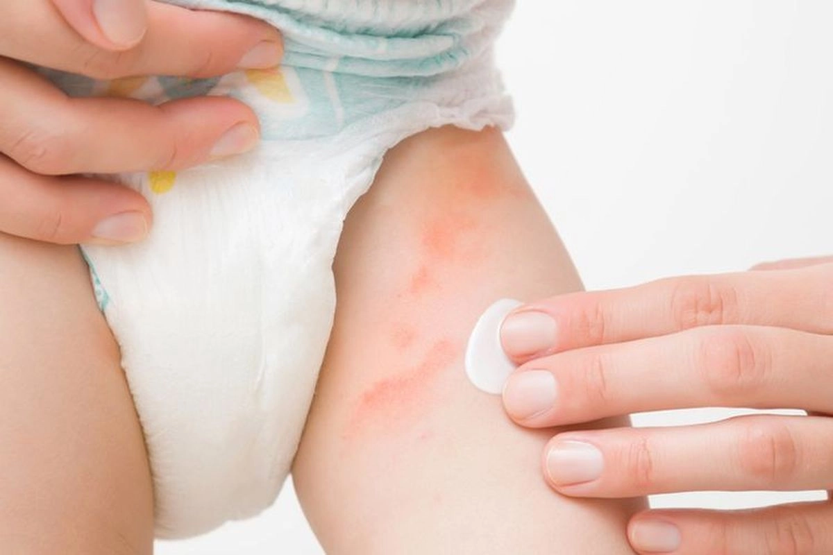 Kenapa Kulit Bayi Mudah Mengalami Ruam Popok? Dokter Jelaskan Sebabnya