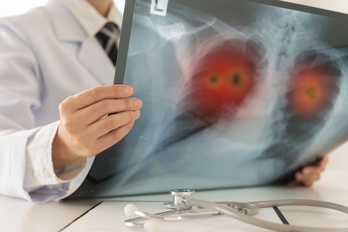 Infeksi Pernapasan Bisa Berdampak pada Jantung, Ini Penjelasan Dokter