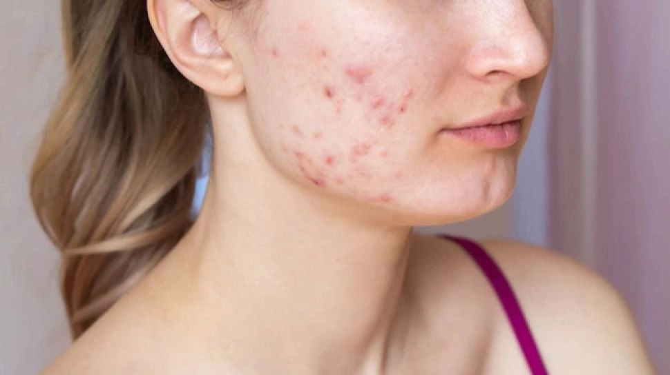 5 Kandungan Skincare yang Harus Dihindari Kulit Berjerawat, Cek Sebelum Membeli