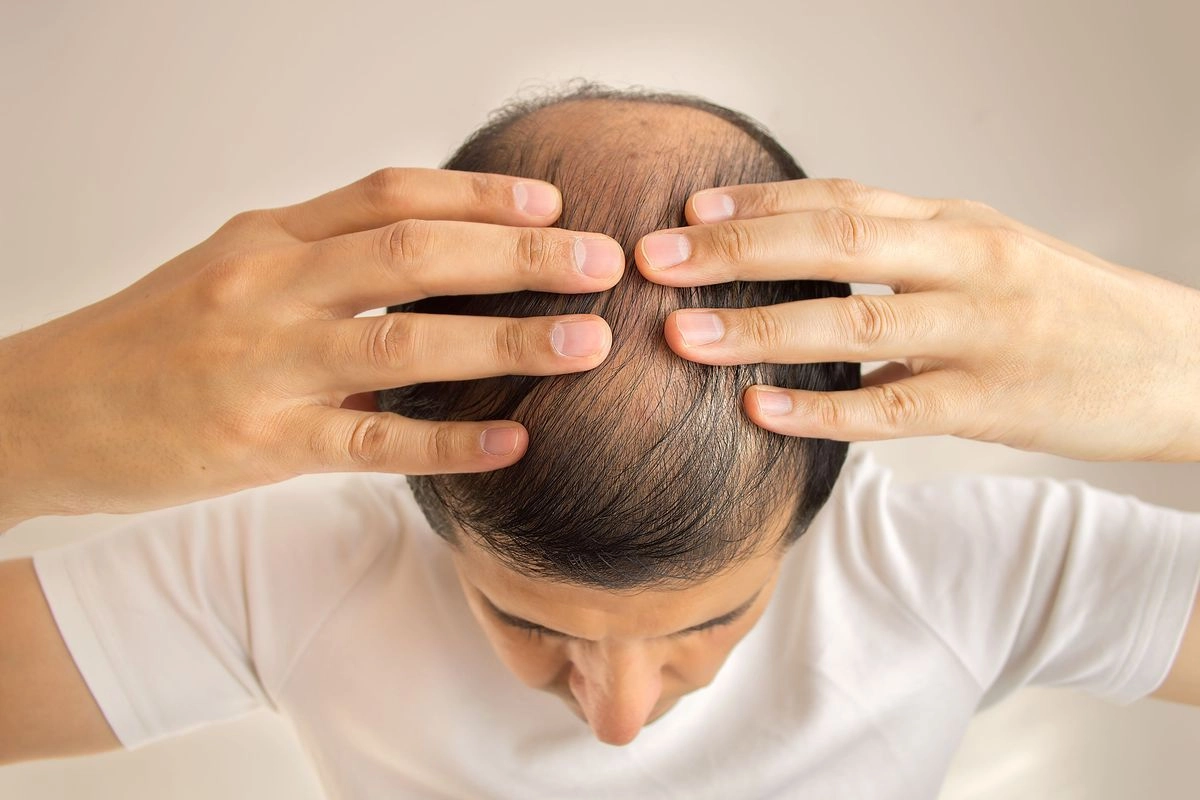 Beda Rambut Rontok dan Kebotakan pada Pria