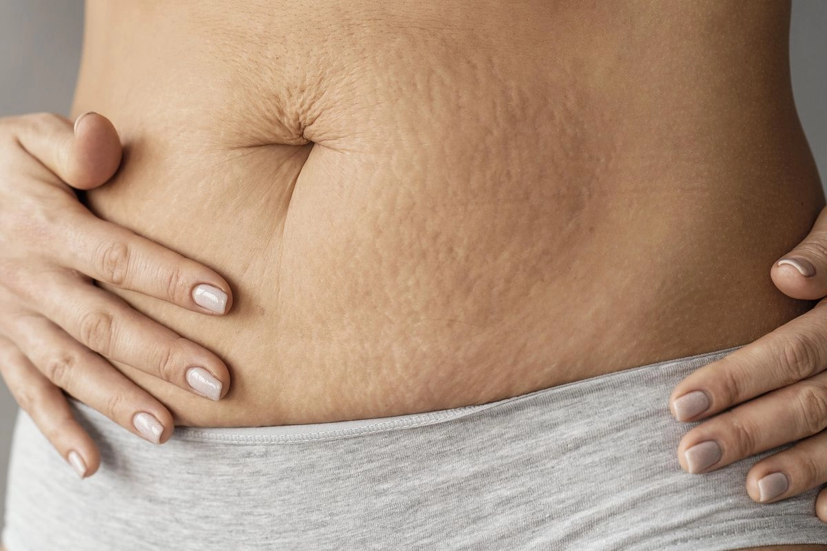 7 Cara Mencegah Stretch Mark agar Tak Makin Parah