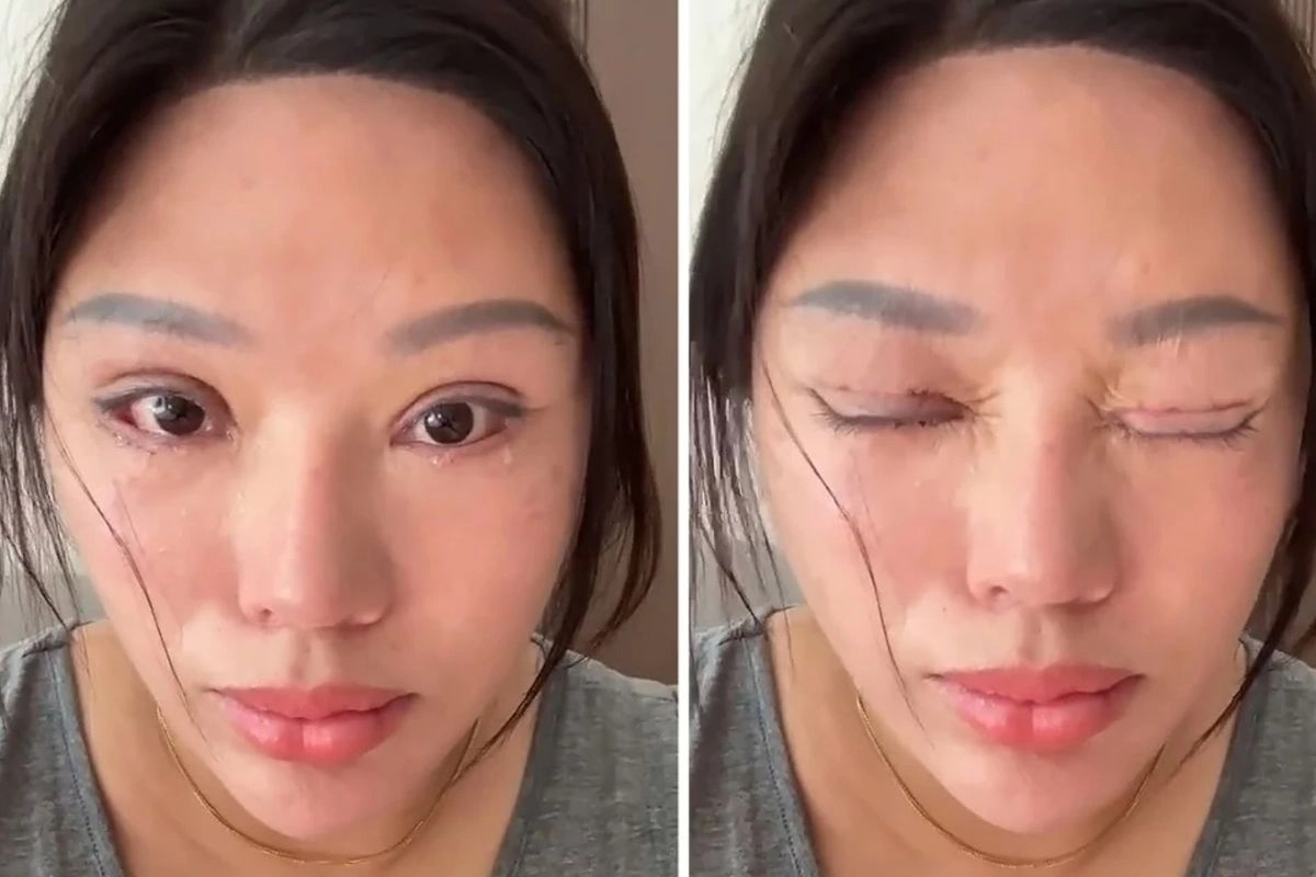 Operasi Kelopak Mata Gagal, Wanita Ini Tak Bisa Tidur Terpejam