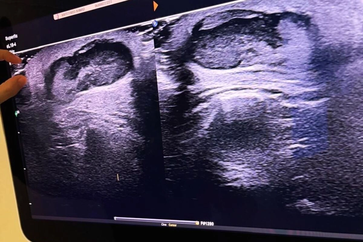 Belajar dari Kasus Raffi Ahmad, Mengapa Benjolan di Tubuh Tidak Boleh Dianggap Sepele?